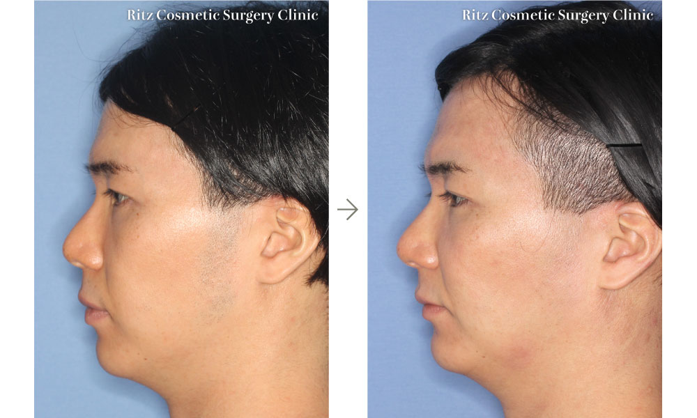 症例写真：下顎枝矢状分割法（SSRO）＋ルフォーI型骨切り術（LeFort-1）(左側面)
