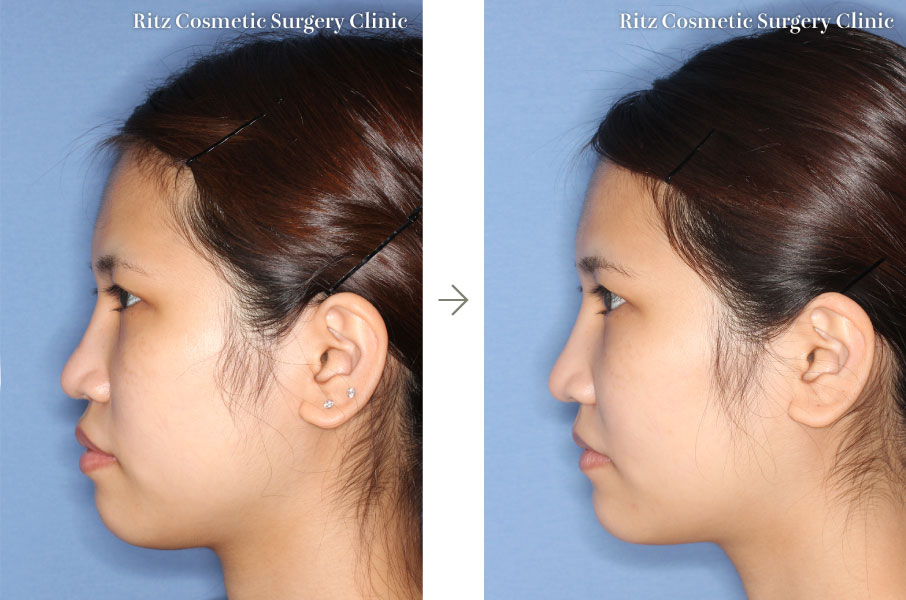 症例写真：下顎枝矢状分割法（SSRO）＋ルフォーI型骨切り術（LeFort-1）(左側面)