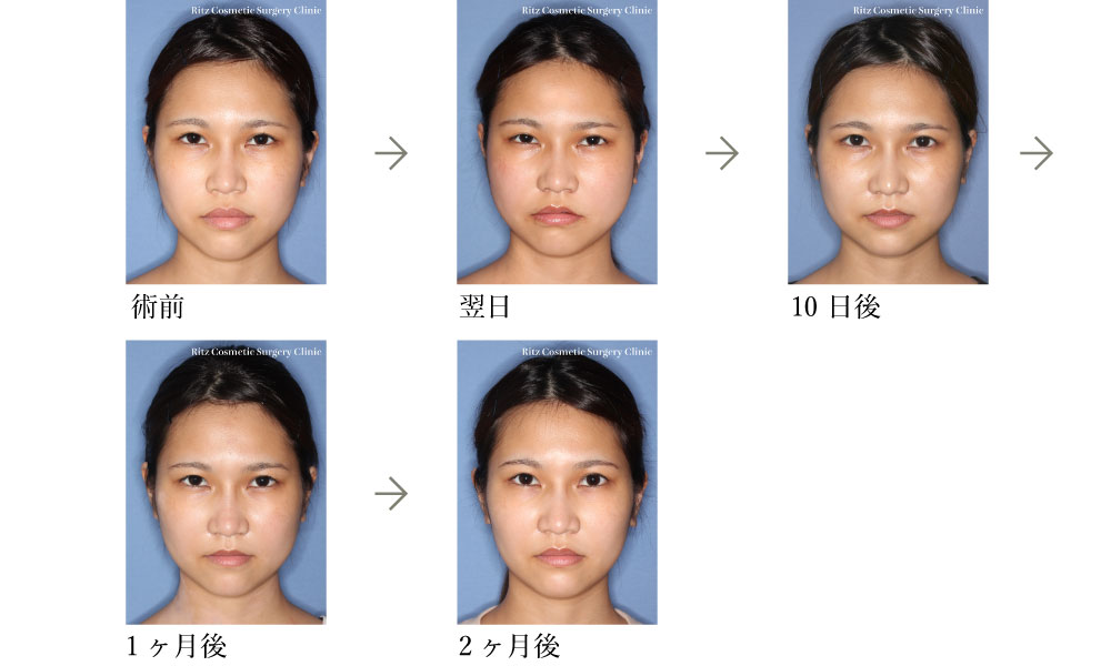 症例写真(腫れの変化)：Lefort-1＋下顎枝矢状分割法（SSRO）