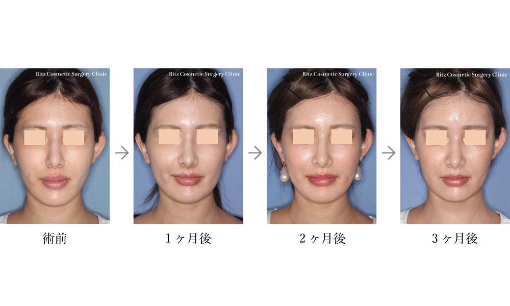 症例写真(腫れの変化)：Lefort-1＋下顎枝矢状分割法（SSRO）