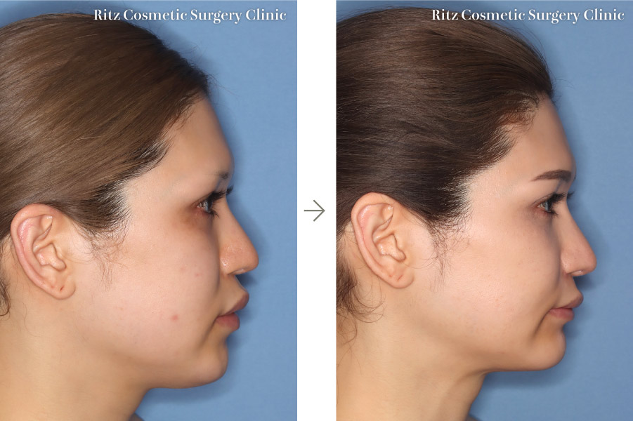 症例写真：下顎枝矢状分割法（SSRO）＋ルフォーI型骨切り術（LeFort-1）(右側面)