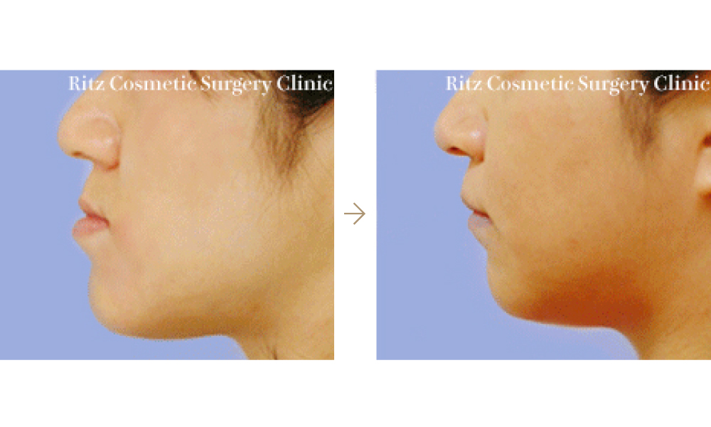 骨格性下顎前突症：下顎枝矢状分割法（SSRO）の症例写真