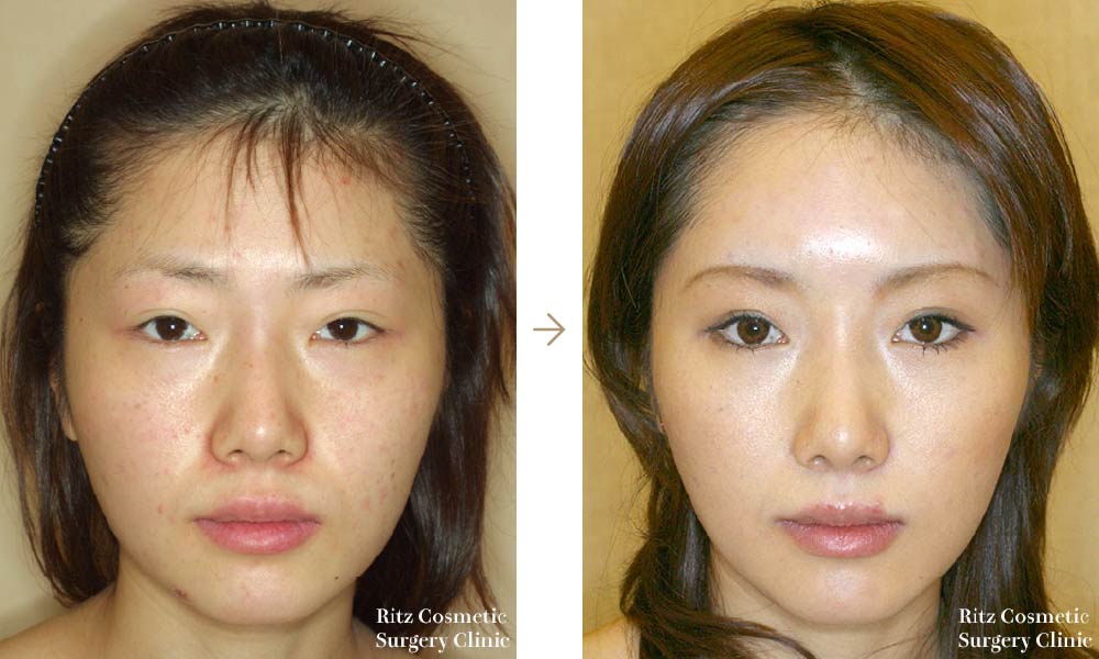 症例写真：内視鏡前額（上眼瞼）リフト＋皺眉筋切除(正面)