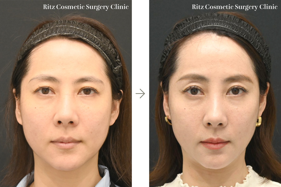 症例写真：内視鏡前額（上眼瞼）リフト