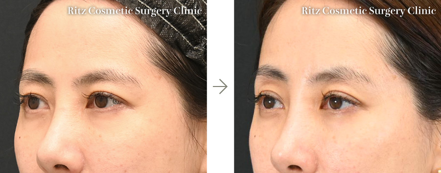 症例写真：内視鏡前額（上眼瞼）リフト