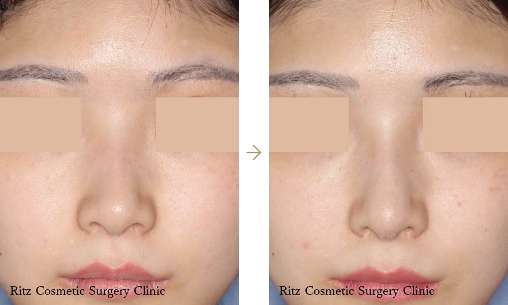症例写真：エラ骨切り＋頬骨骨切り/鼻尖鼻柱形成＋鼻シリコンプロテーゼ(正面)