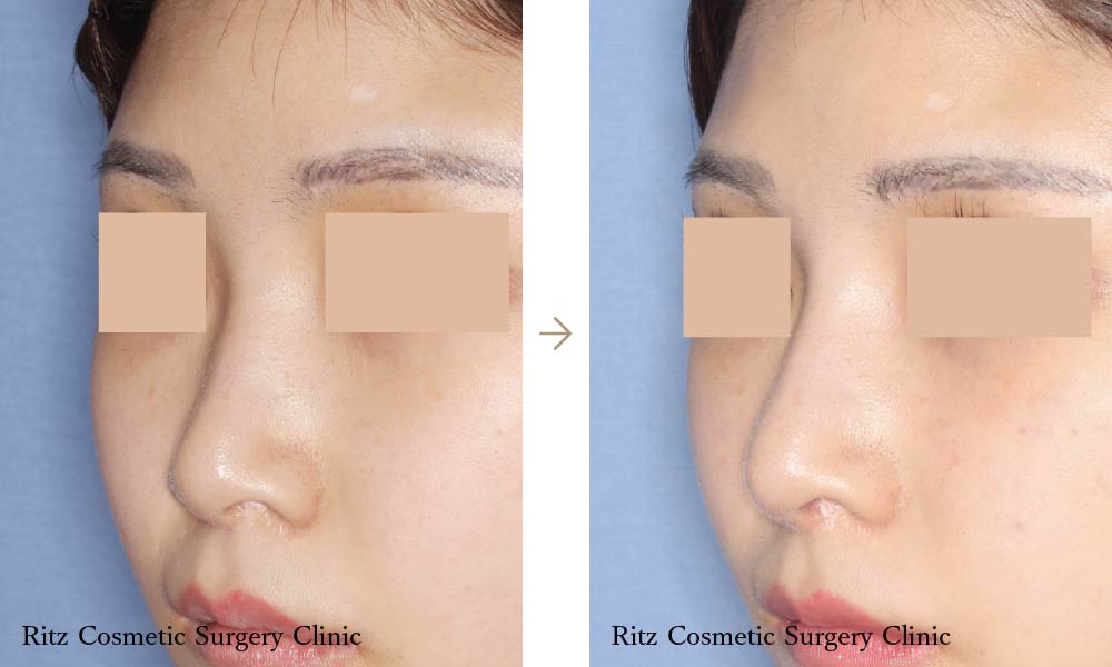 症例写真：エラ骨切り＋頬骨骨切り/鼻尖鼻柱形成＋鼻シリコンプロテーゼ(左斜め)