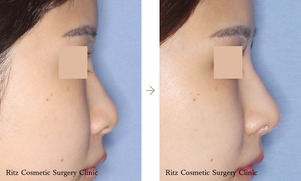 症例写真：エラ骨切り＋頬骨骨切り/鼻尖鼻柱形成＋鼻シリコンプロテーゼ(右側面)