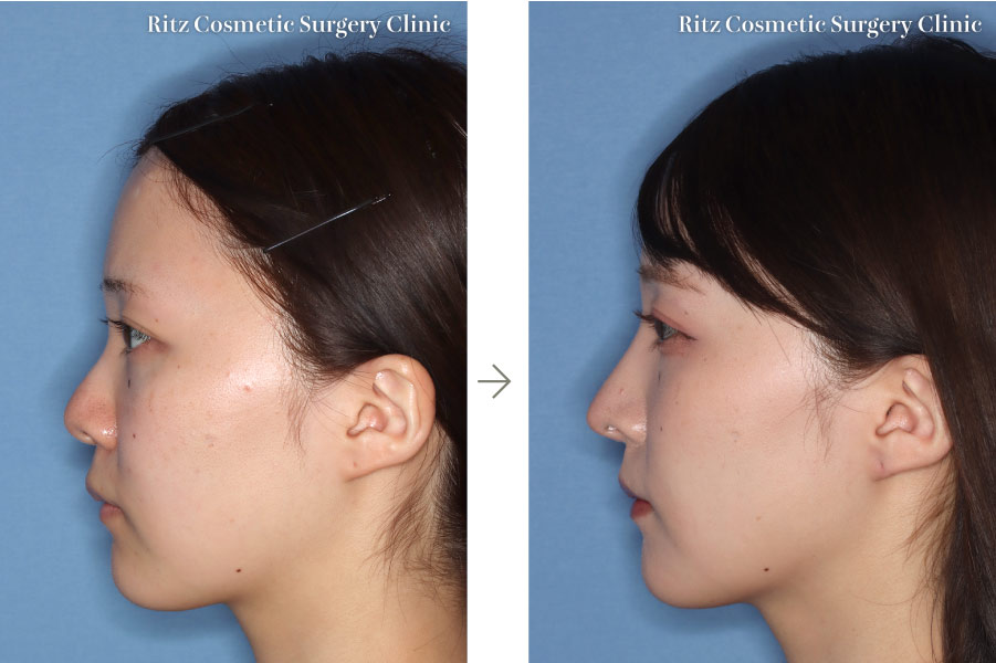 症例写真：鼻中隔延長＋鼻プロテーゼ(左側面)