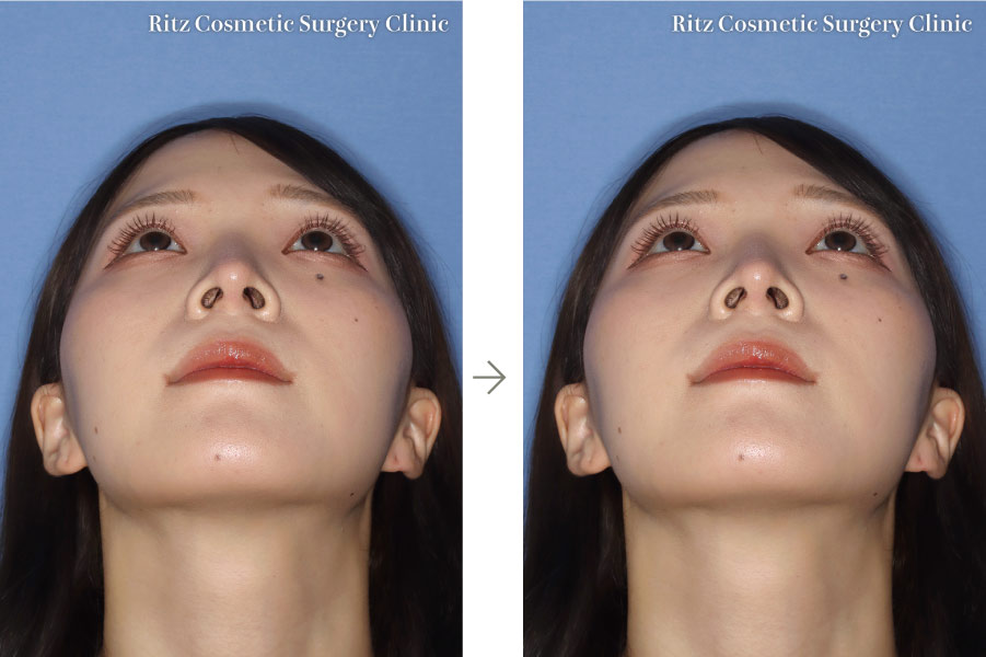 症例写真：鼻中隔延長＋鼻プロテーゼ(あおり視点)
