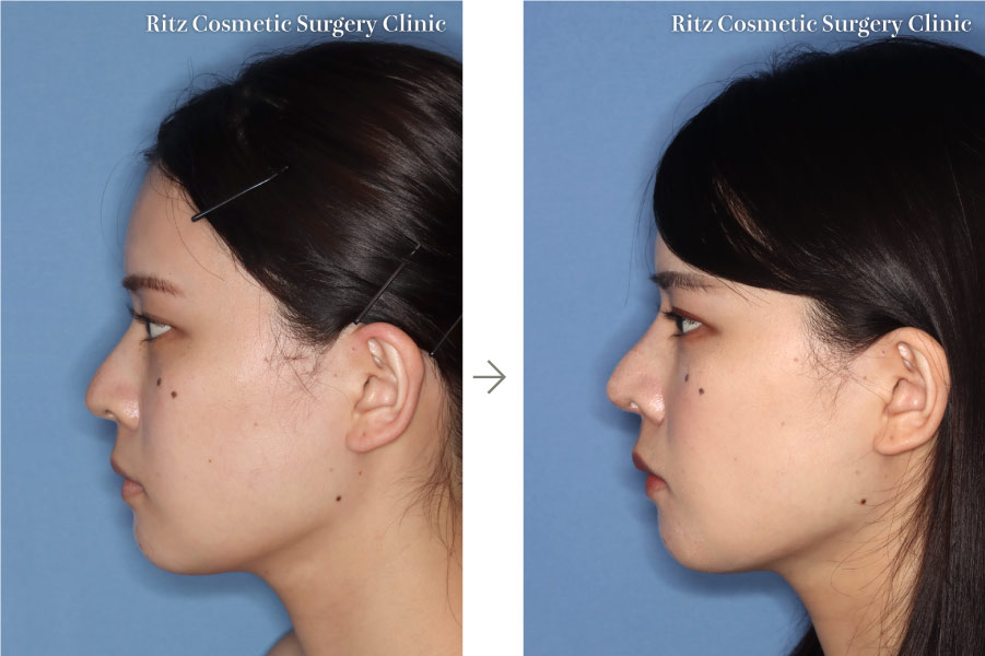 症例写真：鼻中隔延長＋鼻プロテーゼ(左側面)