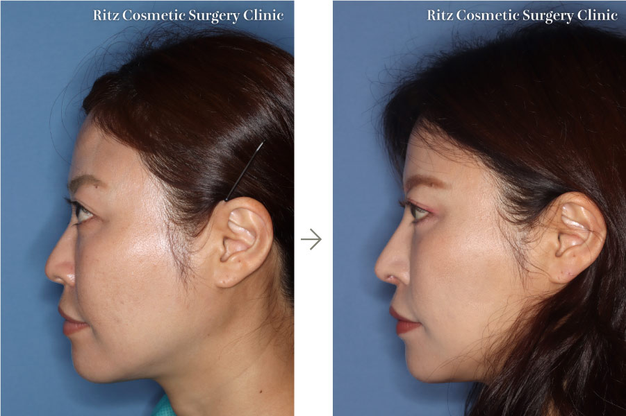 症例写真：鼻中隔延長＋鼻シリコンプロテーゼ＋額脂肪注入＋下眼瞼下制術(左側面)