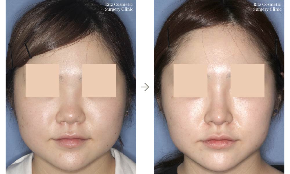 症例写真：鼻中隔延長術＋シリコンインプラント(正面)