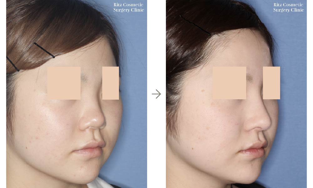 症例写真：鼻中隔延長術＋シリコンインプラント(右斜め)