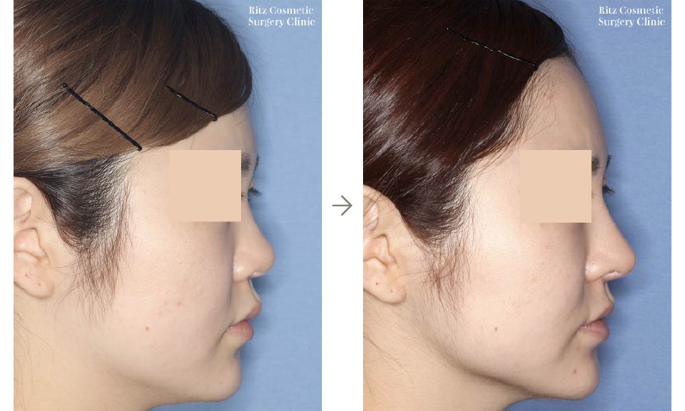 症例写真：鼻中隔延長術＋シリコンインプラント(右側面)
