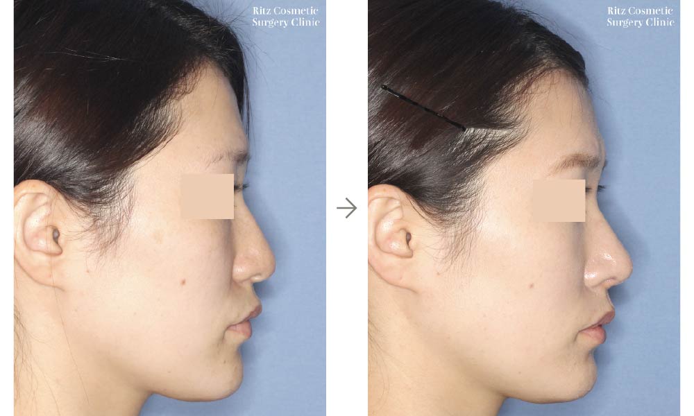 症例写真：鼻尖形成術(右側面)