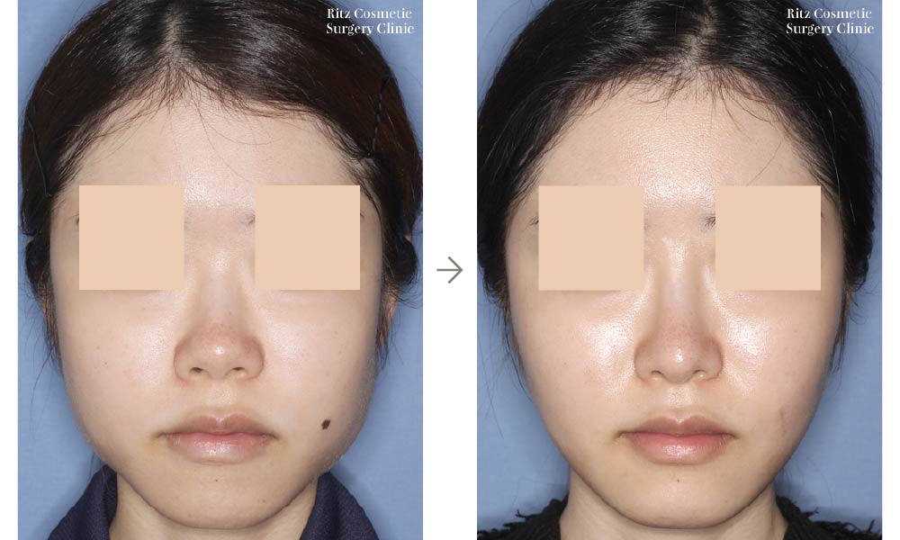 症例写真：鼻中隔延長術＋シリコンインプラント(正面)