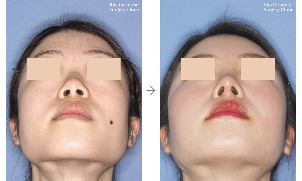 症例写真：鼻中隔延長術＋シリコンインプラント(仰ぐ)