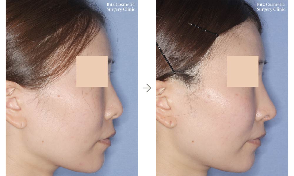 症例写真：鼻中隔延長術＋鼻骨骨切り術＋鼻中隔湾曲矯正(右側面)