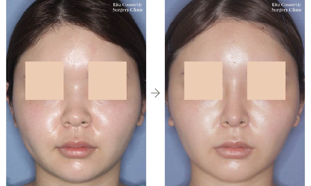 症例写真：鼻中隔延長術＋シリコンインプラント（正面）