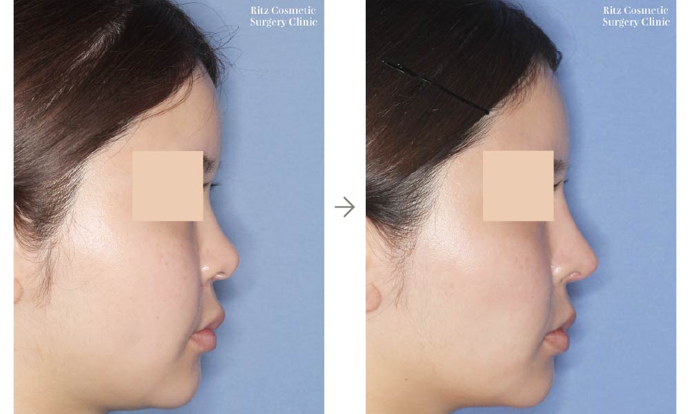 症例写真：鼻中隔延長術＋シリコンインプラント（右側面）