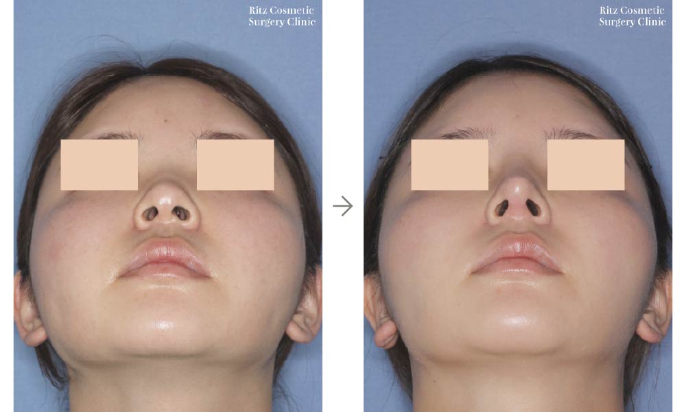 症例写真：鼻中隔延長術＋シリコンインプラント（仰ぐ）