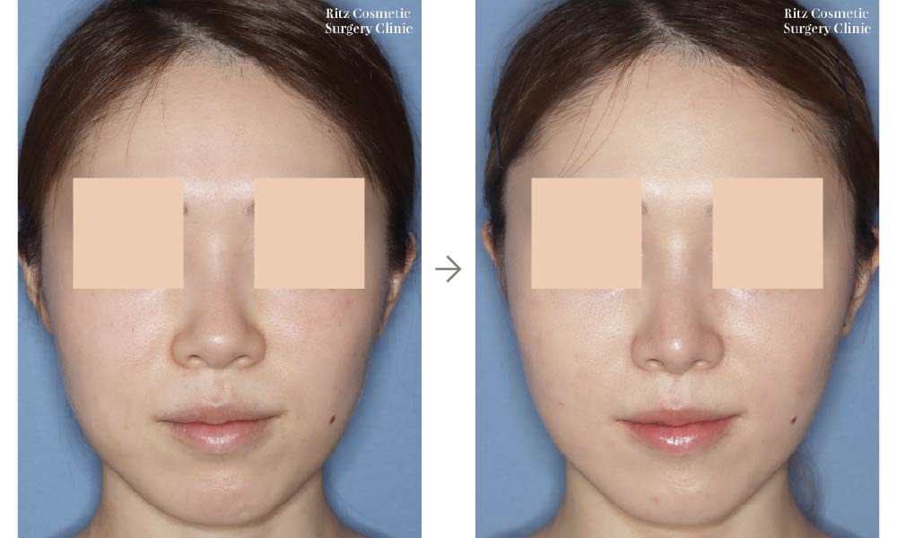 症例写真：鼻尖形成術＋シリコンインプラント（正面）