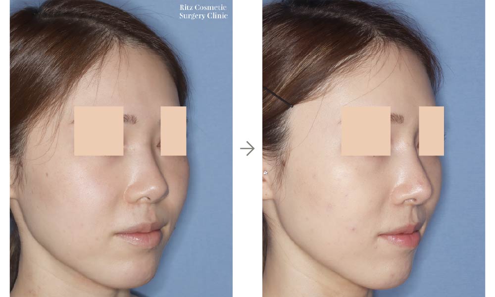 症例写真：鼻尖形成術＋シリコンインプラント（右斜め）