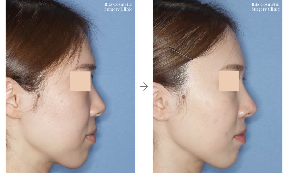 症例写真：鼻尖形成術＋シリコンインプラント（右側面）
