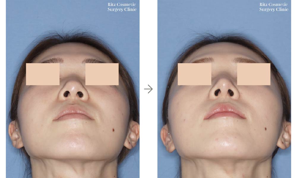 症例写真：鼻尖形成術＋シリコンインプラント（仰ぐ）