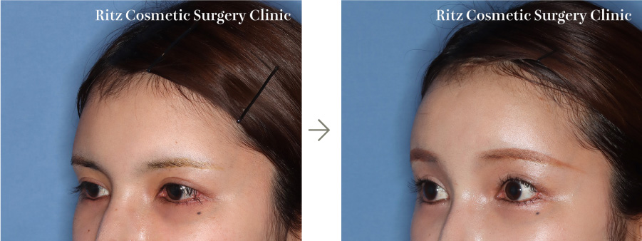 症例写真：内視鏡前額リフト（額〜眉毛〜上眼瞼）(左斜め)