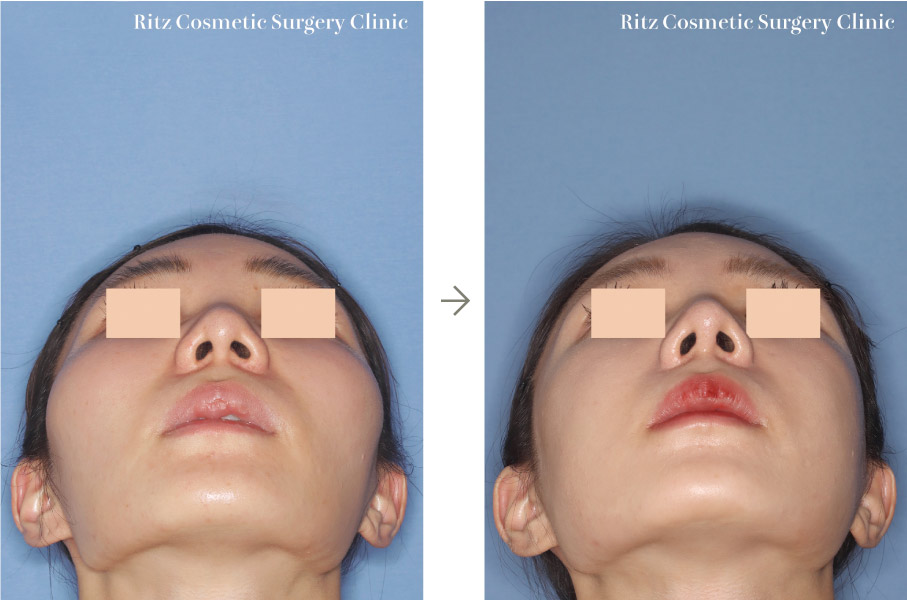 症例写真：頬骨縮小術（※同時に鼻形成術も行っています）（下部）
