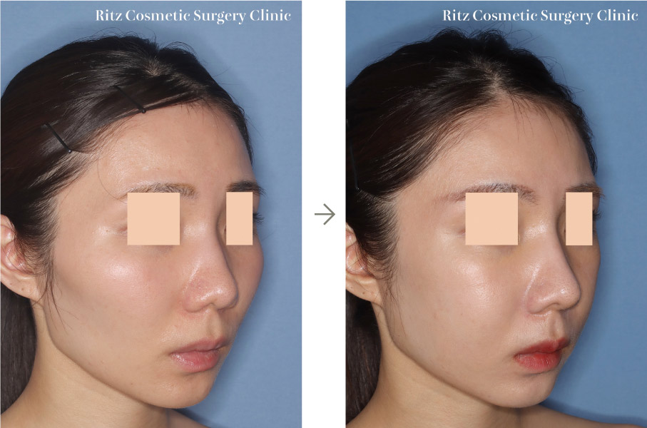 症例写真：頬骨縮小術（※同時に鼻形成術も行っています）（左側面）