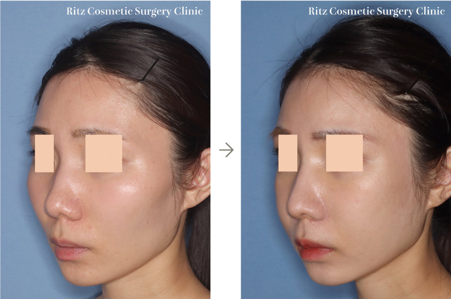症例写真：頬骨縮小術（※同時に鼻形成術も行っています）（右側面）