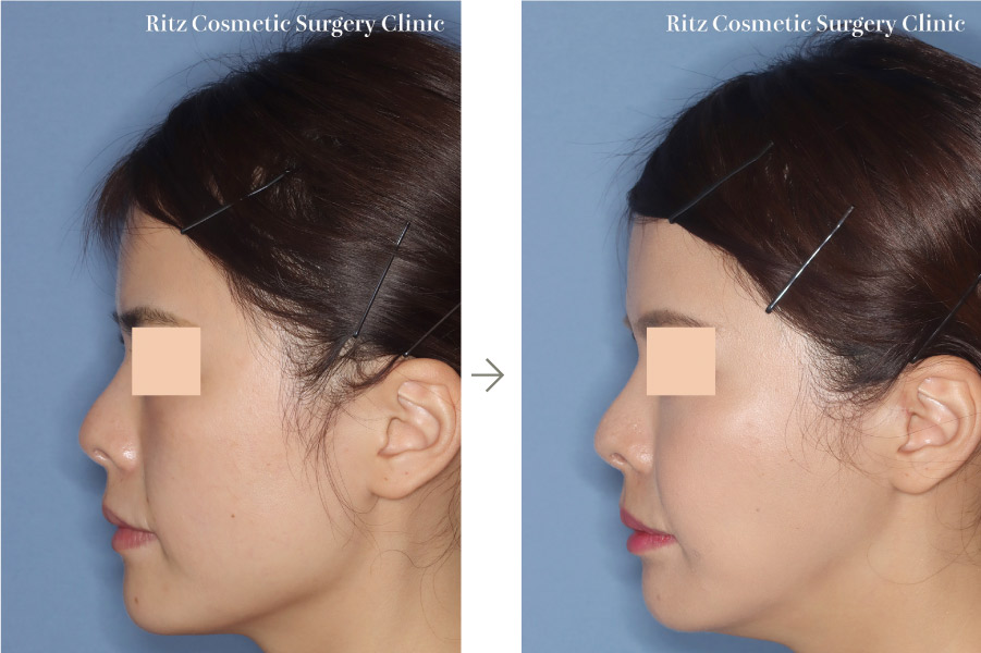 症例写真：下顎形成術（下顎角切除＋外板切除＋咬筋焼灼）＋頬骨縮小術(左側面)