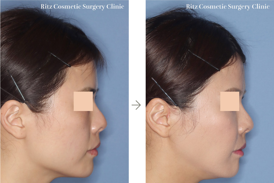 症例写真：下顎形成術（下顎角切除＋外板切除＋咬筋焼灼）＋頬骨縮小術(右側面)