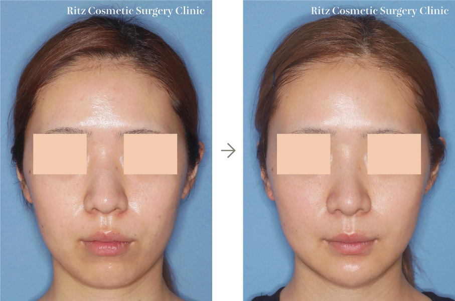 症例写真：オトガイVライン形成術＋顎下脂肪吸引（※同時に鼻形成術も行っています）（正面）