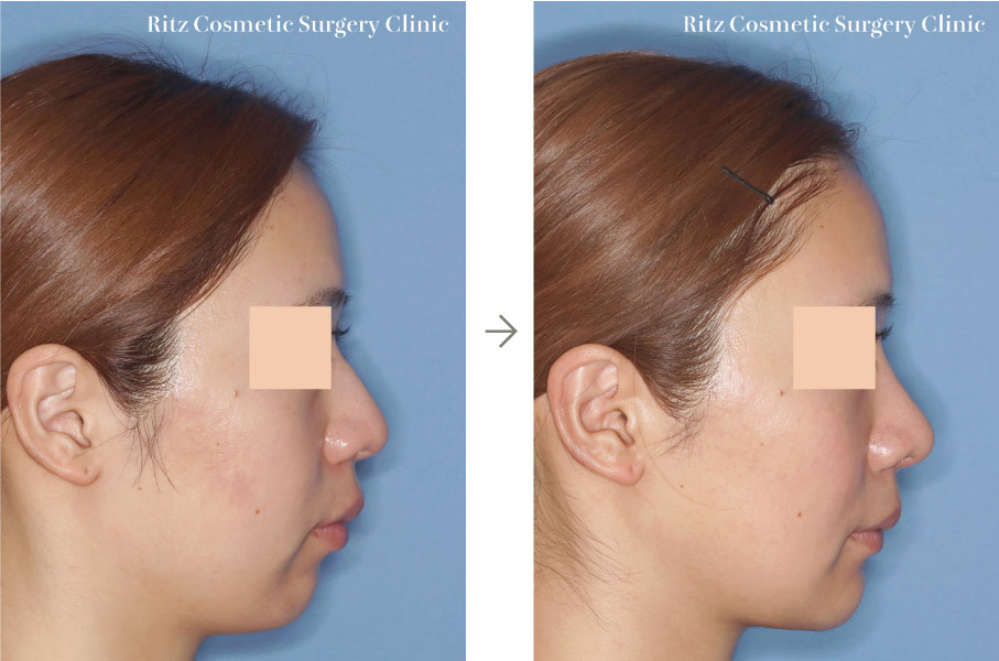症例写真：オトガイVライン形成術＋顎下脂肪吸引（※同時に鼻形成術も行っています）（右側面）