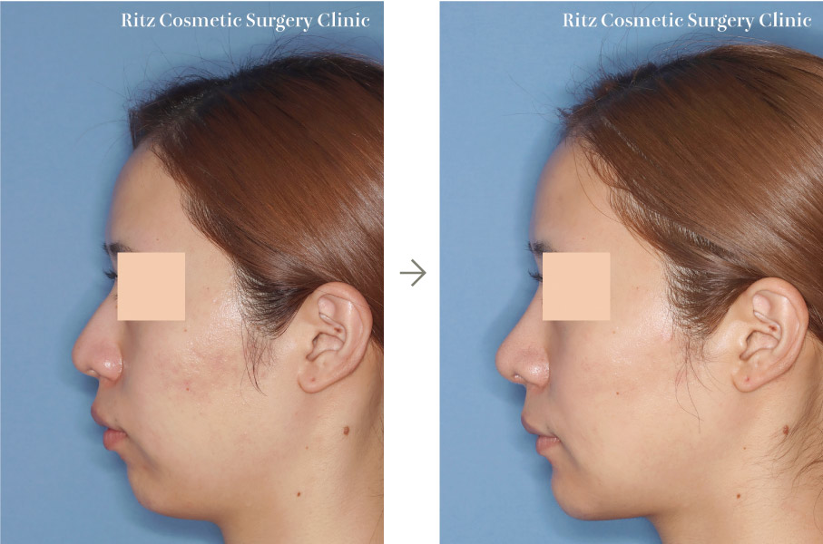 症例写真：オトガイVライン形成術＋顎下脂肪吸引（※同時に鼻形成術も行っています）（左側面）