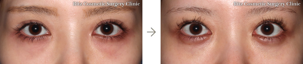 症例写真：裏ハムラ法（正面）