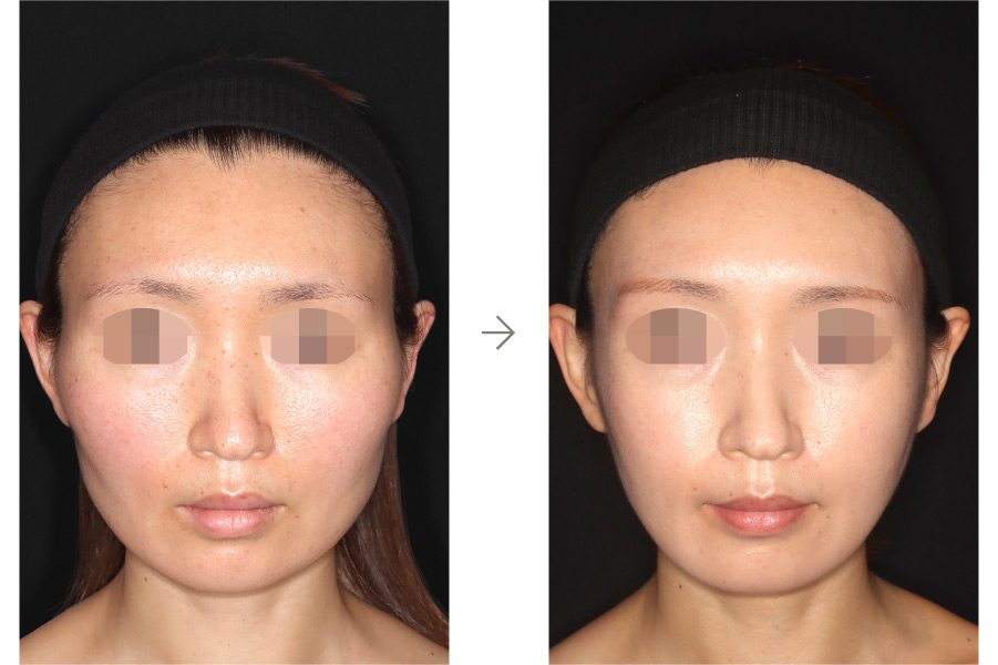 症例写真：鼻中隔延長術＋鼻シリコンインプラント(正面)