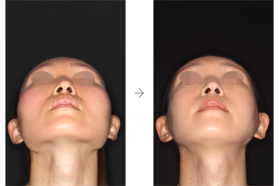 症例写真：鼻中隔延長術＋鼻シリコンインプラント(左側面)