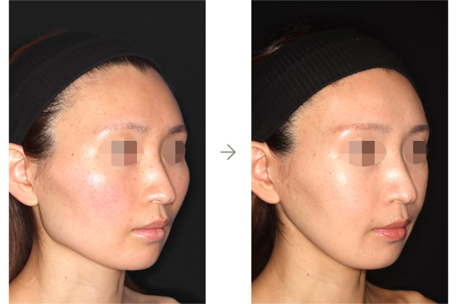 症例写真：鼻中隔延長術＋鼻シリコンインプラント(右側面)