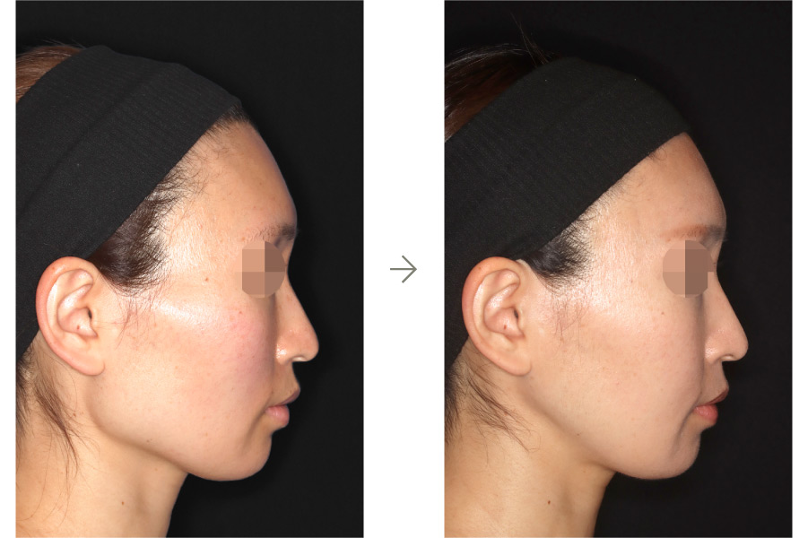 症例写真：鼻中隔延長術＋鼻シリコンインプラント(左斜め)