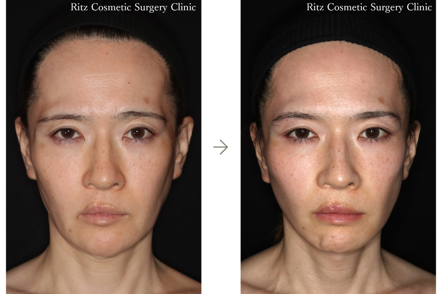 症例写真：フェイスネックリフト（Extended Deep Plane Facelift） 眉骨削り