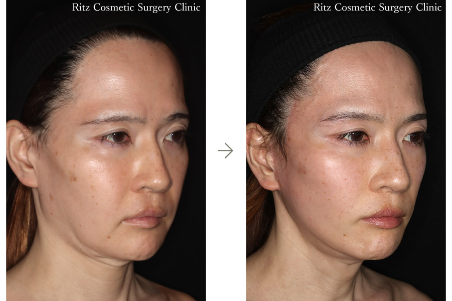 症例写真：フェイスネックリフト（Extended Deep Plane Facelift） 眉骨削り