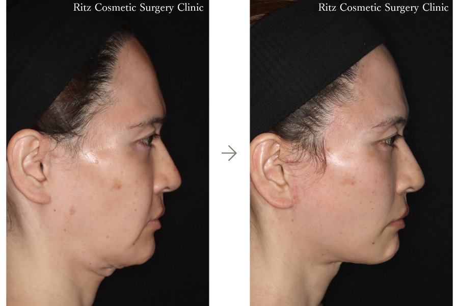 症例写真：フェイスネックリフト（Extended Deep Plane Facelift） 眉骨削り