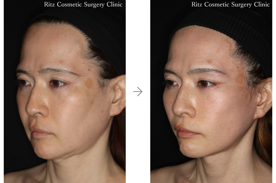 症例写真：フェイスネックリフト（Extended Deep Plane Facelift） 眉骨削り