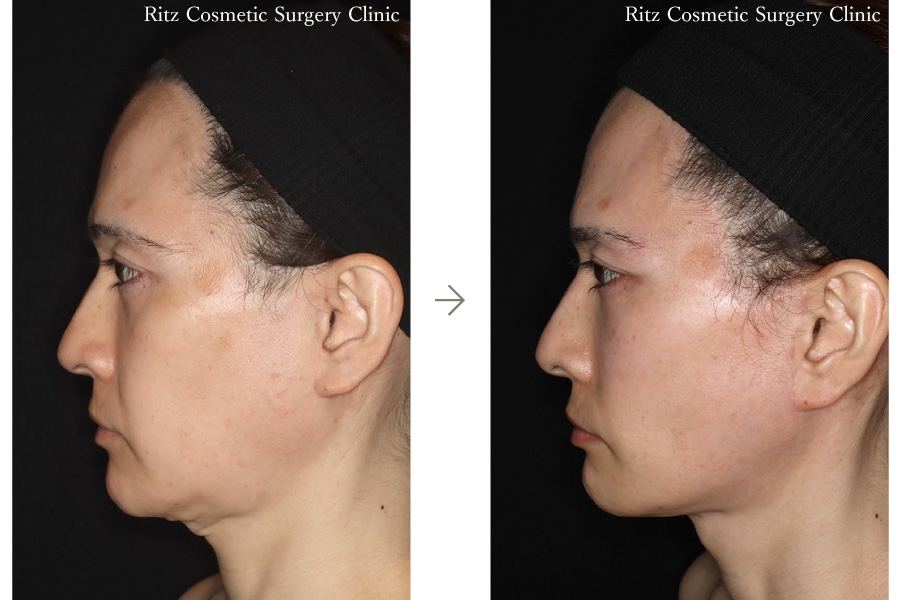 症例写真：フェイスネックリフト（Extended Deep Plane Facelift） 眉骨削り