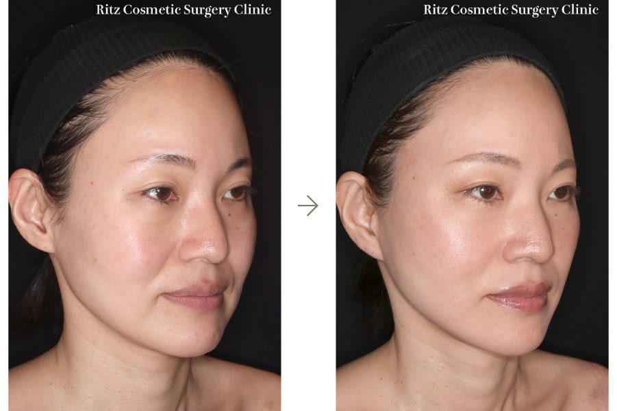 症例写真：フェイスネックリフト（Extended Deep Plane Facelift） 裏ハムラ法